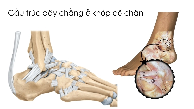  Cấu trúc dây chằng ở khớp cổ chân dễ bị chấn thương