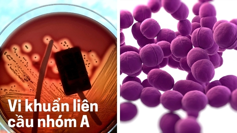  Vi khuẩn liên cầu nhóm A là nguyên nhân gây viêm họng phổ biến