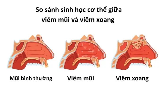 Lý giải vì sao chúng ta có thể bị viêm mũi thường xuyên