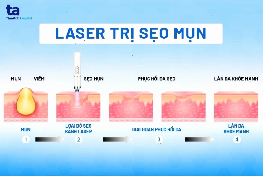 Sử dụng laser để điều trị sẹo mụn hiệu quả