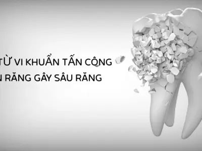 Axit trong men răng hoạt động - Vì sao chúng ta cần đánh răng?