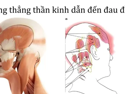 Vì sao chúng ta bị đau đầu? Cơ chế gây ra cơn đau