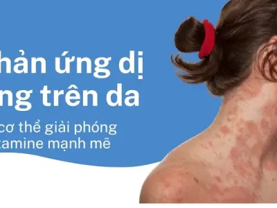 Vì sao chúng ta bị dị ứng? Khi hệ miễn dịch ứng quá mức