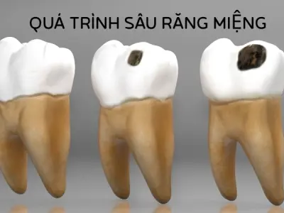 Vì sao răng bị sâu? Các giai đoạn phát triển