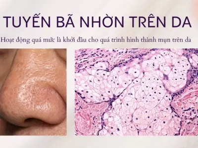 Vì sao chúng ta bị nổi mụn? Hormone gây ra mụn